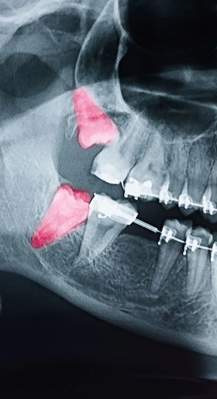 extractions pesky wisdom teeth