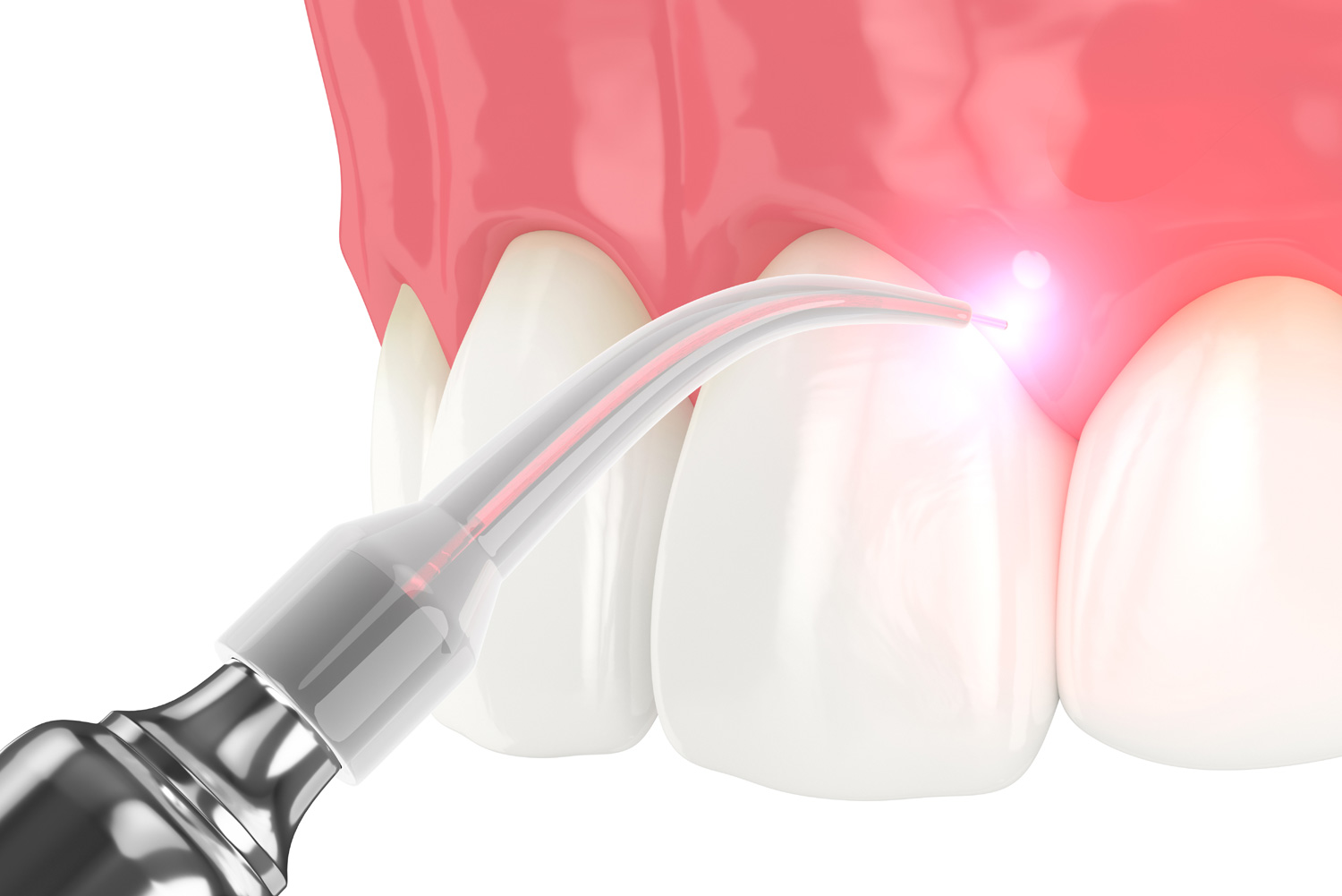 dental diode laser used to treat gums