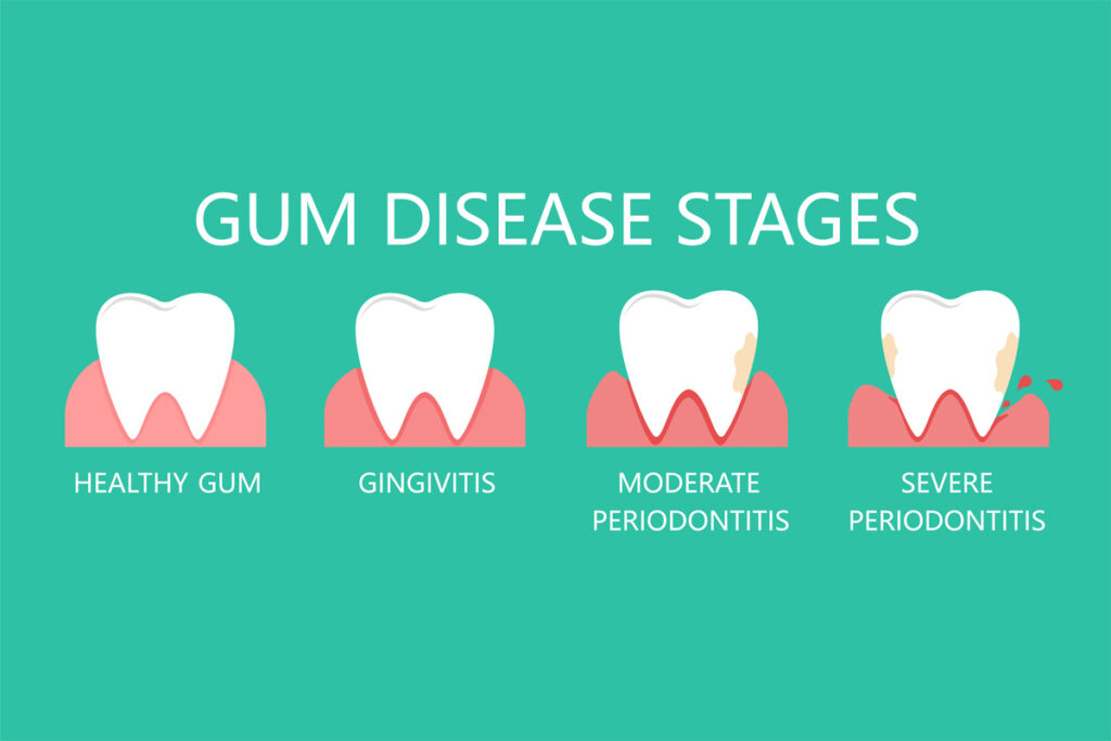 Stomatological concept. The stages of gum disease, the stage of development of dental periodontitis. Vector illustration.