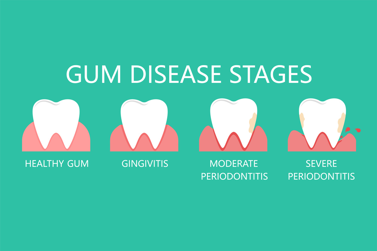 Stomatological concept. The stages of gum disease, the stage of development of dental periodontitis. Vector illustration.