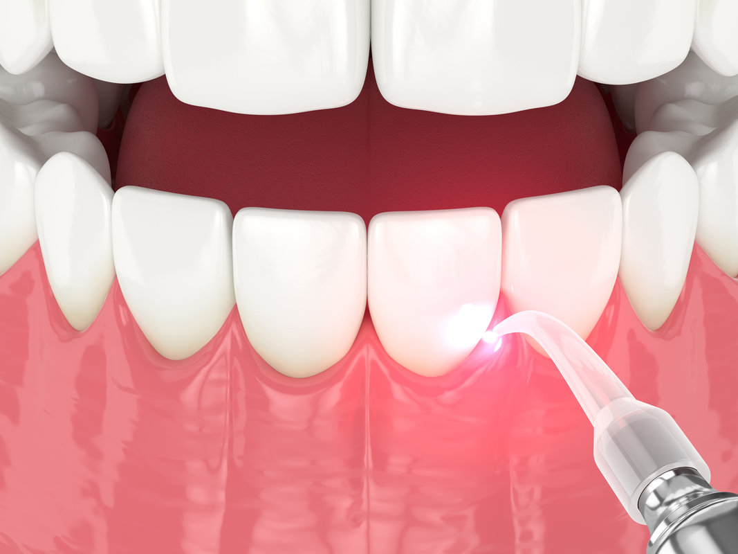 3d render of dental diode laser used to treat gums