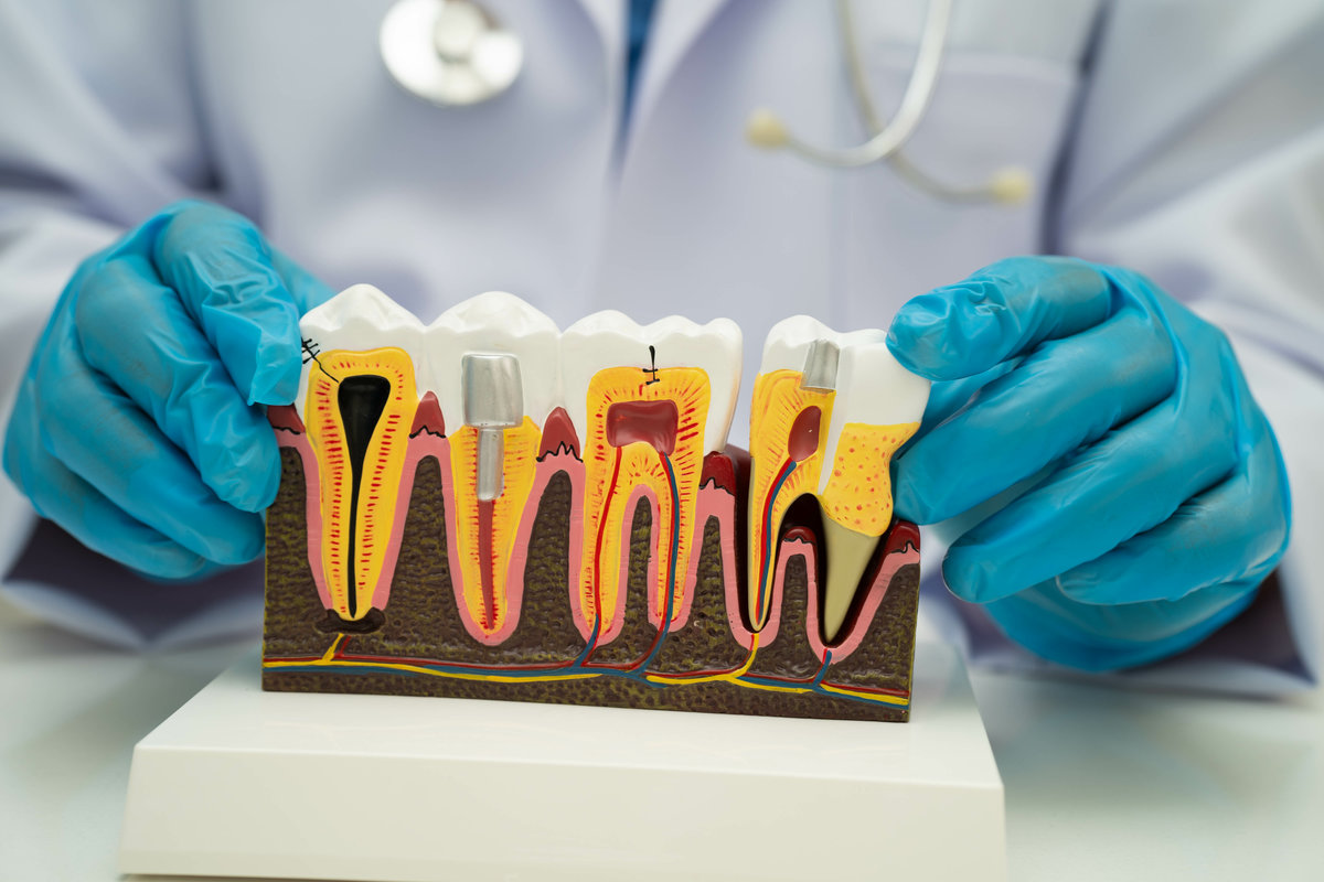 Dentist holding dental implant, artificial tooth roots into jaw, root canal of dental treatment, gum disease, teeth model for dentist.